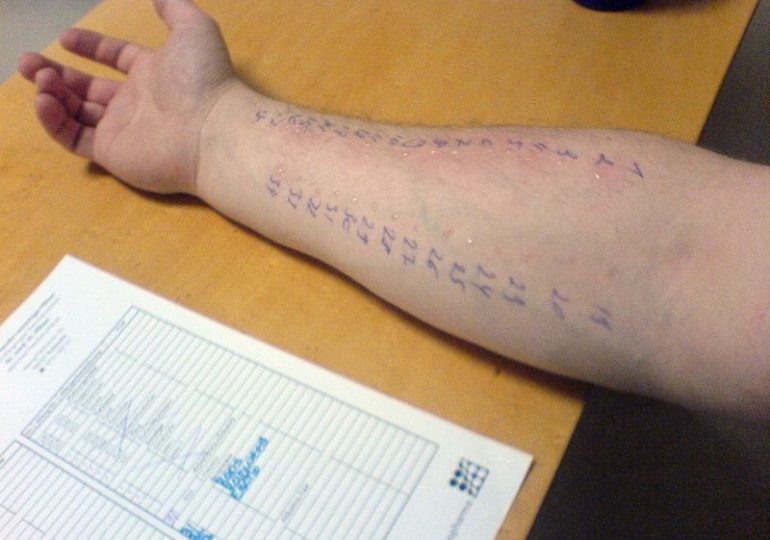 Rodzaje testów alergicznych